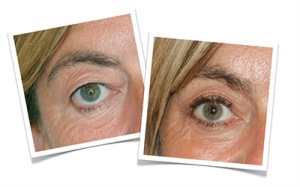 Notice the changes after Blepharoplasty?