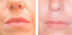 Restylane Injections in Concord and North Charlotte